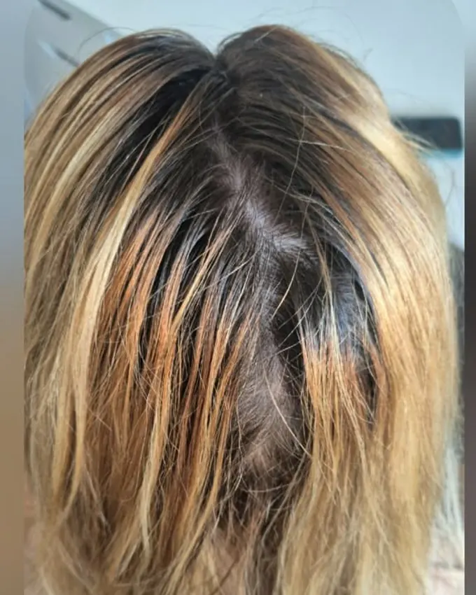 Grown-out roots with warm patches after home bleaching